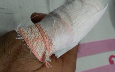 The case of the missing Thumb ?!